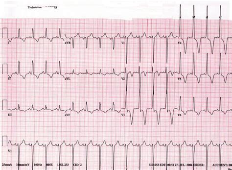 left ventricular hypertrophy with qrs widening.